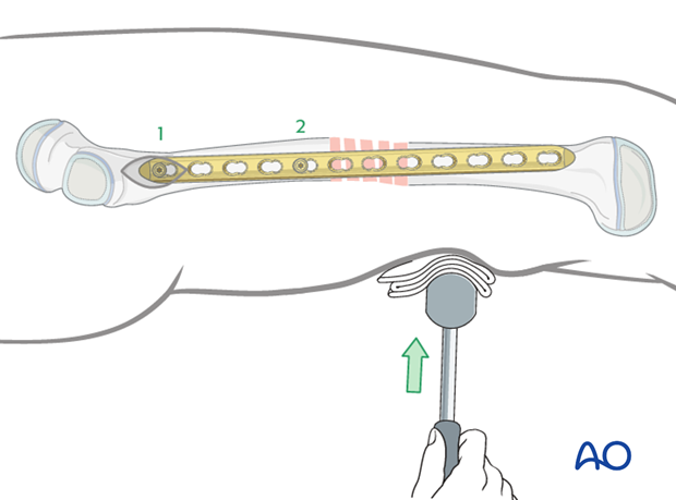 Reduction with a bump placed under the fracture