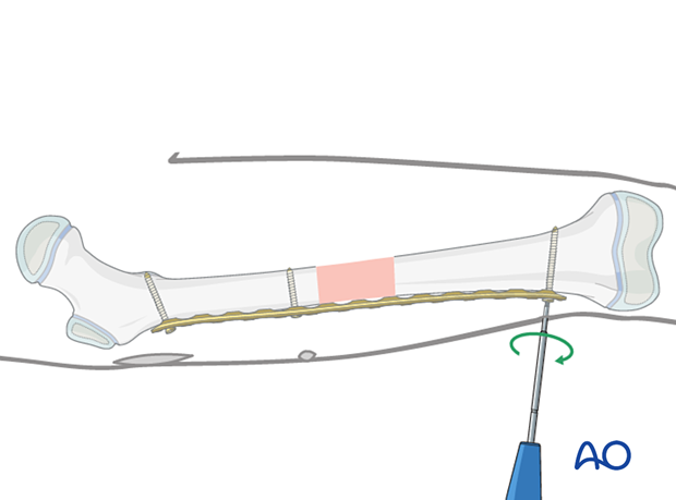 Confirmation of correct position and insertion of the third screw