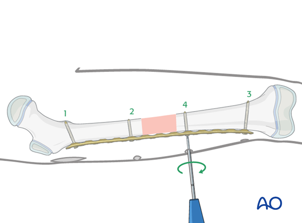 Insertion of the fourth screw