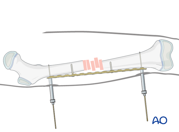 Temporary attachment of the plate with locking towers