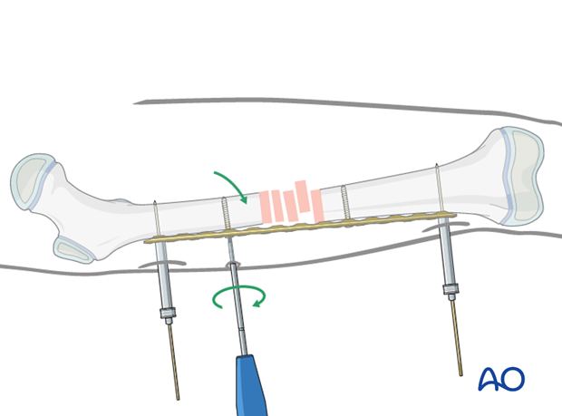 Reduction with insertion of conventional screws