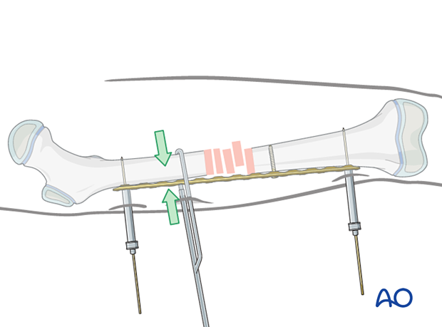 Reduction with a bone holding clamp