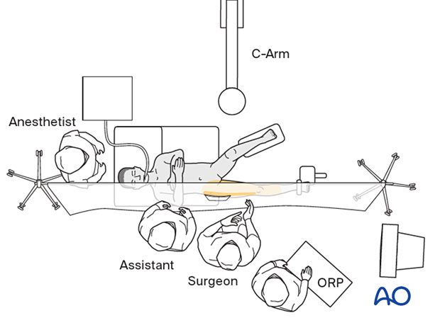 OR set-up for ALFN