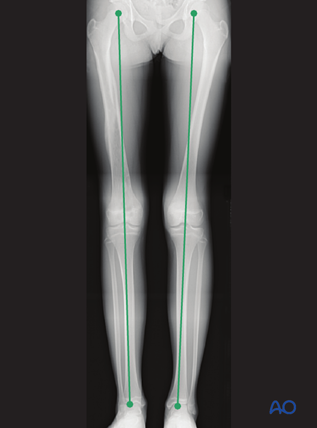 Leg length measured in a long-leg x-ray from femoral head to ankle joint