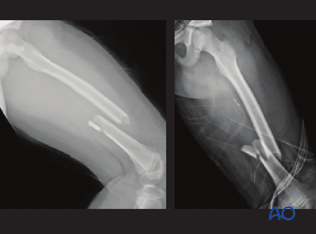 Patient position for AP view x-rays