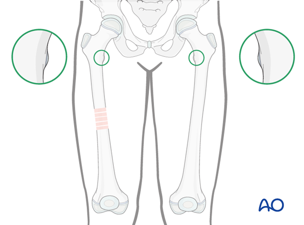 Matching of the lesser trochanter shape