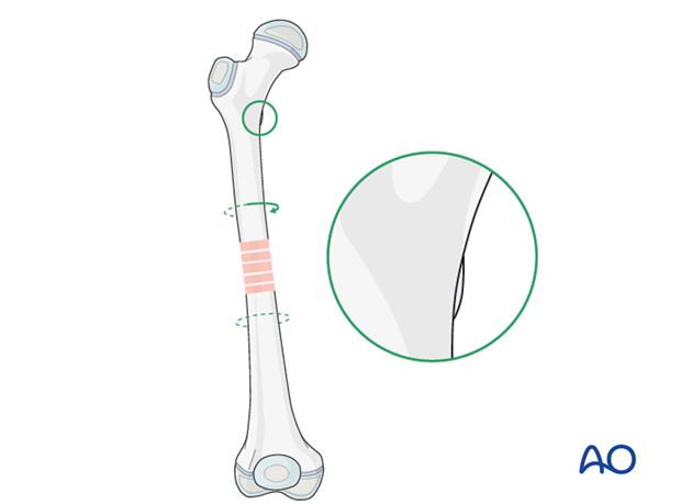 Internal malrotation of the proximal fragment