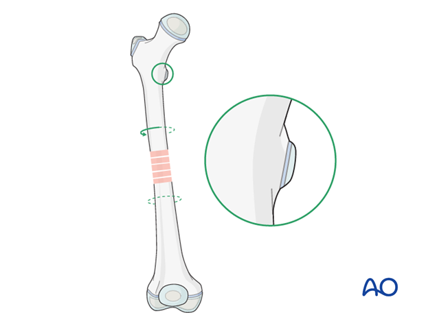 External malrotation of the proximal fragment