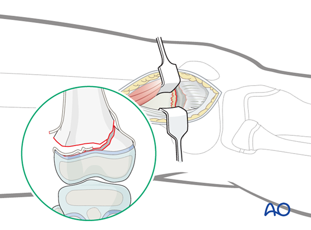 Retraction of vastus lateralis