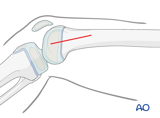 Skin incision for a medial approach