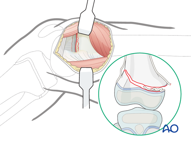 Interposed periosteum attached to the distal epiphyseal fragment