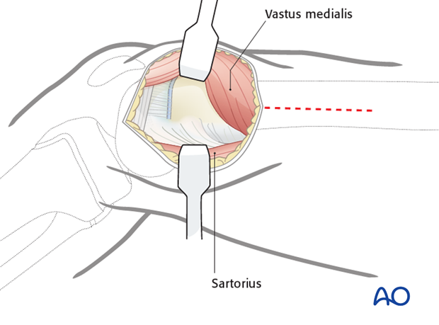 Proximal extension