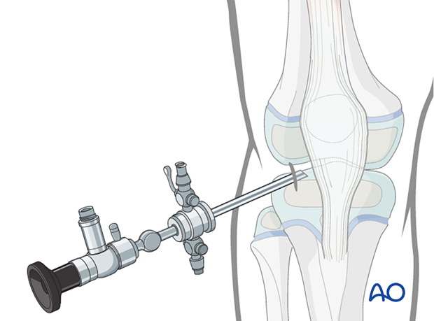 Insertion of the arthroscope