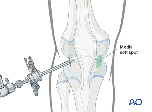 Medial soft spot