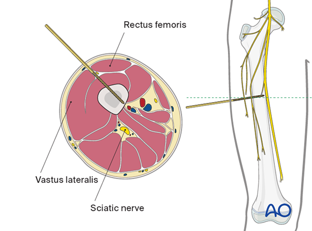 Anterolateral approach