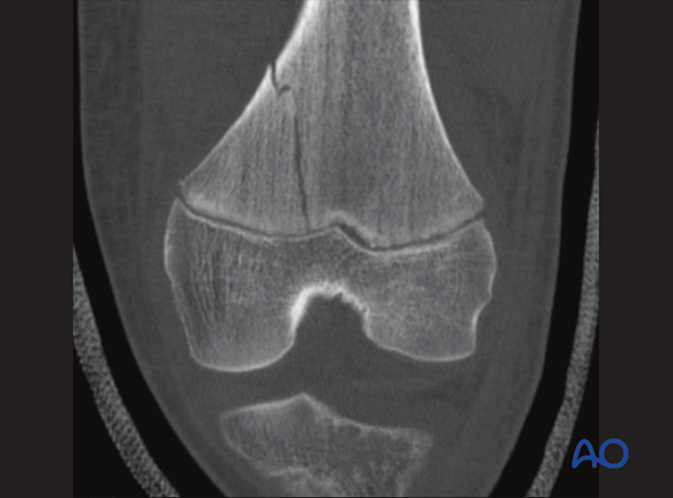 CT scan of a minimally displaced Salter-Harris II fracture