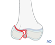 33-E/3 Epiphyseal, SH III