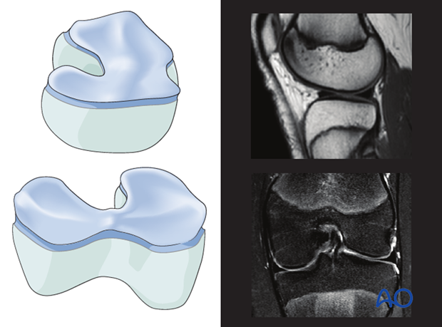 Anatomy of distal femoral growth plate