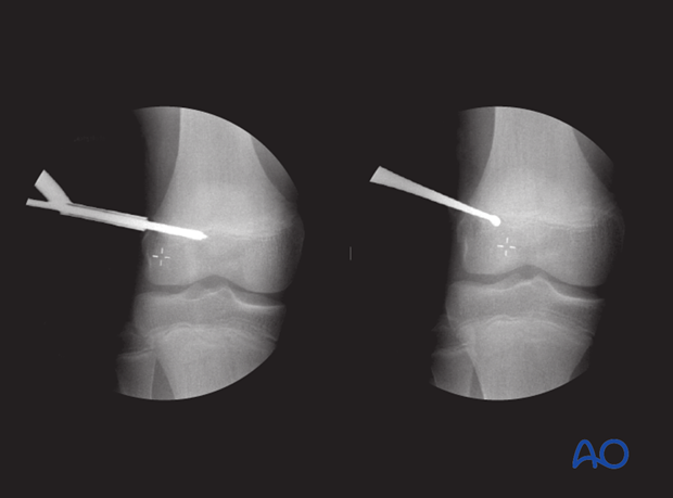 Epiphysiodesis of the opposite side