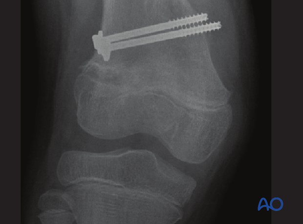 Significant valgus deformity due to cessation on the lateral side