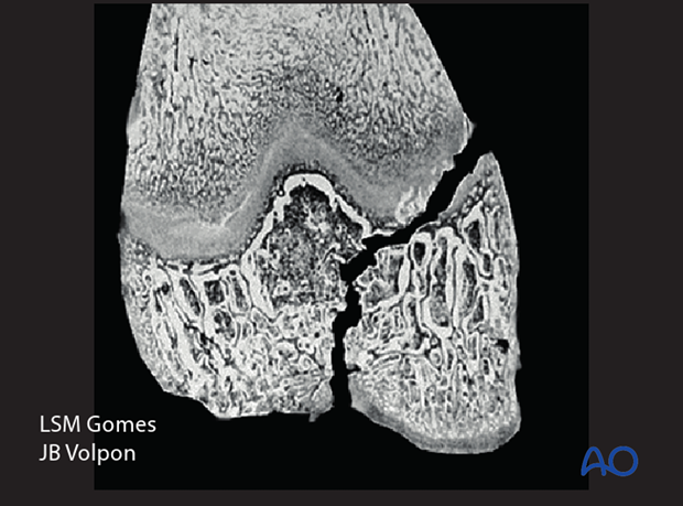 Salter-Harris IV fracture