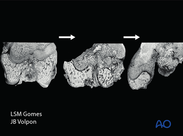 Vascular invasion into the fracture plane of a Salter-Harris IV injury