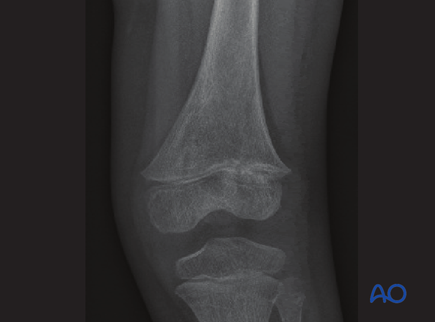 X-ray showing irregularity in the lateral half of the growth plate suggesting early bony bar formation