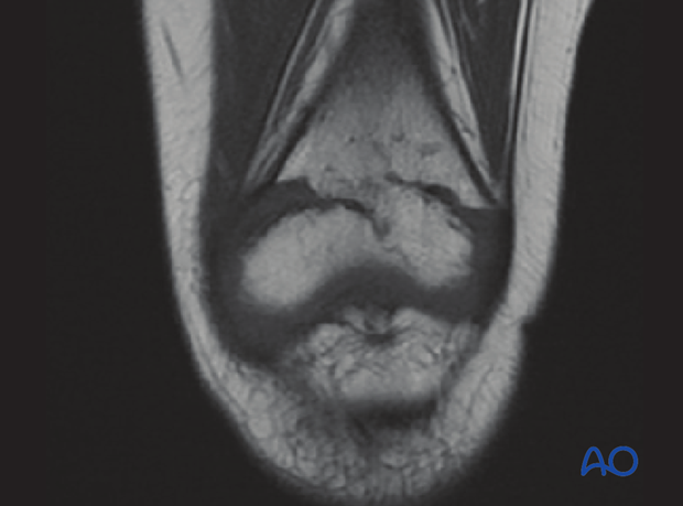 MRI imaging visualizing the growth plate and demonstrating a physeal bar