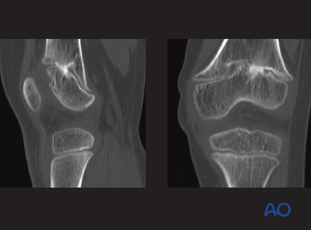 CT imaging confirming an anterolateral bony bar resulting in a valgus and substantial extension deformity