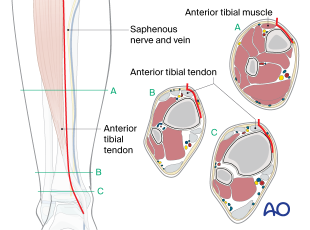 Approach to the anteromedial tibial surface in the child - Take care not to compromise the saphenous vein and nerve.