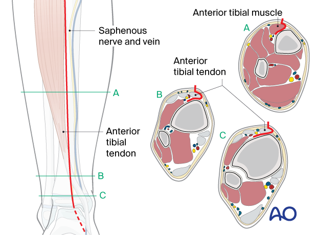 Approach to the anterolateral tibial surface in the child – Deep dissection at different levels