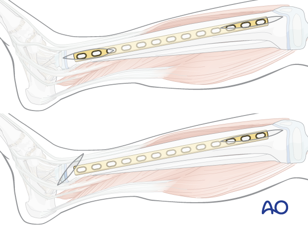 Minimally invasive medial approach to the pediatric tibia – Plate inserted