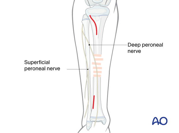 Minimally invasive lateral approach to the pediatric tibia – Skin incisions