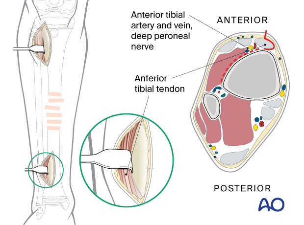 Minimally invasive lateral approach to the pediatric tibia - Distal incision