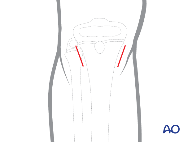 ESIN entry points for antegrade nailing of the pediatric tibia - Skin incision