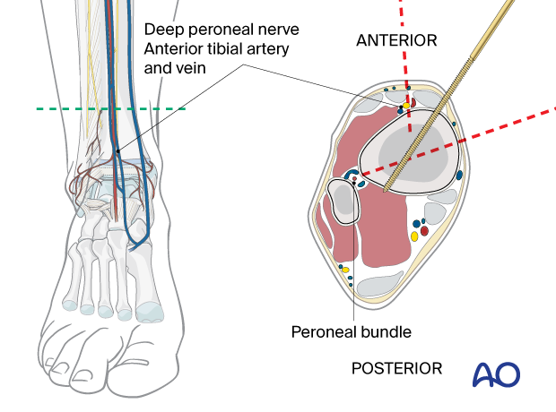 Safe zones for pin placement in the pediatric tibia – Pin insertion in the distal third