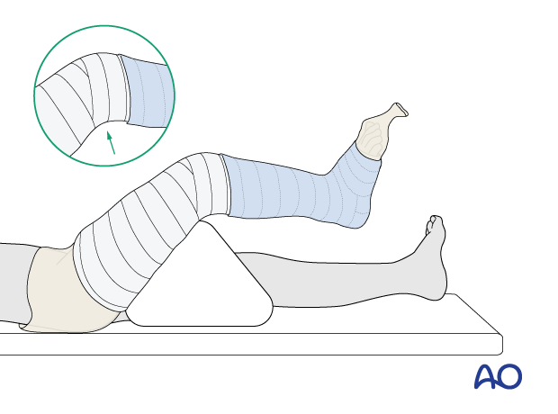 Cast application for long leg cast