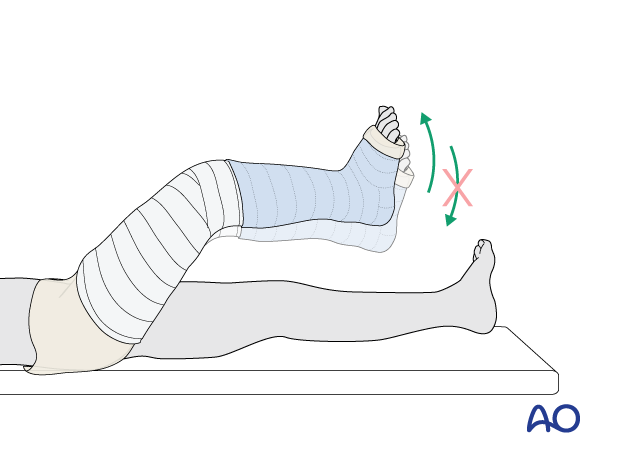 Do not increase knee flexion while applying the upper part of the cast to prevent skin injury behind the knee by the edge of the lower cast.