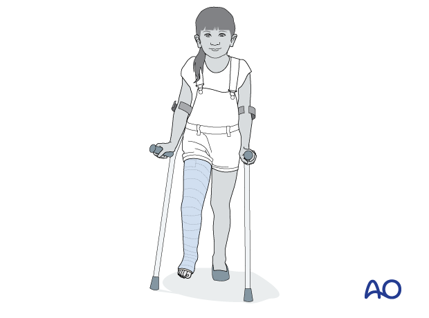 Pediatric patient with long leg cast and crutches