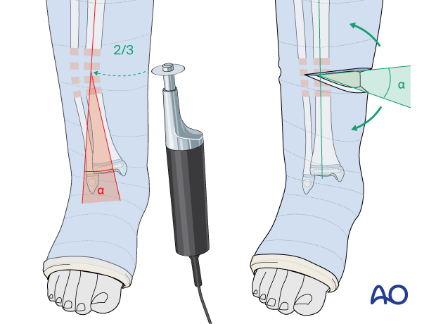 Cast wedging in a long leg cast of a tibial shaft fracture