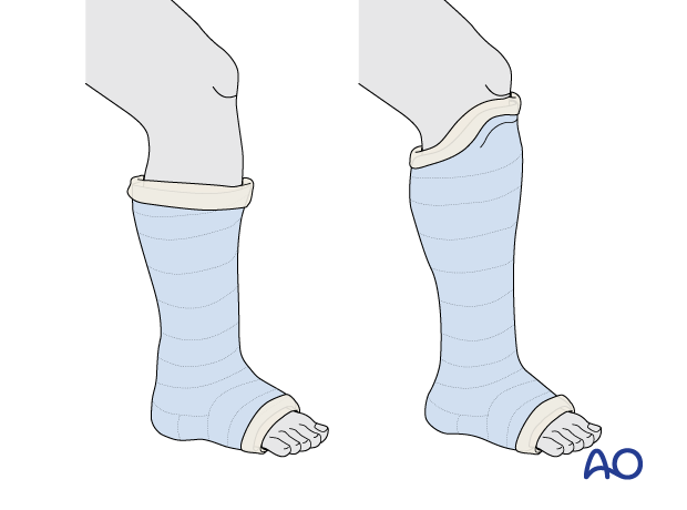 Below-knee cast and patella tendon bearing cast (Sarmiento)