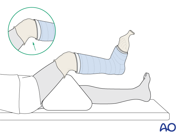 Cast application for short leg cast