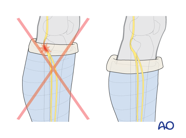 Avoiding pressure over the fibular head and neck with application of a short leg cast