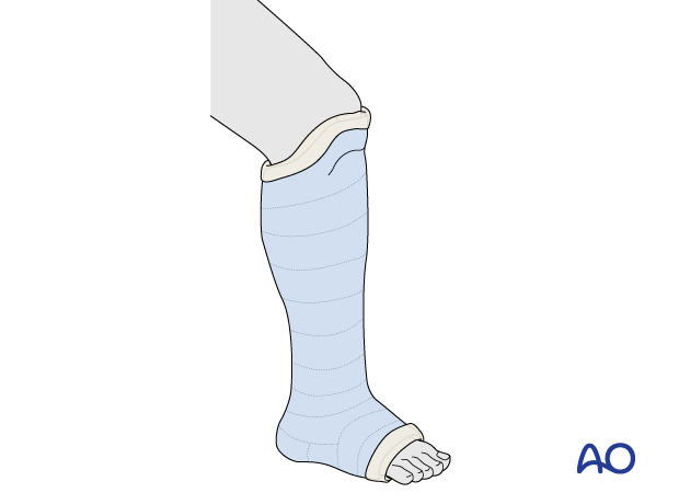 Short leg cast for immobilization of the ankle