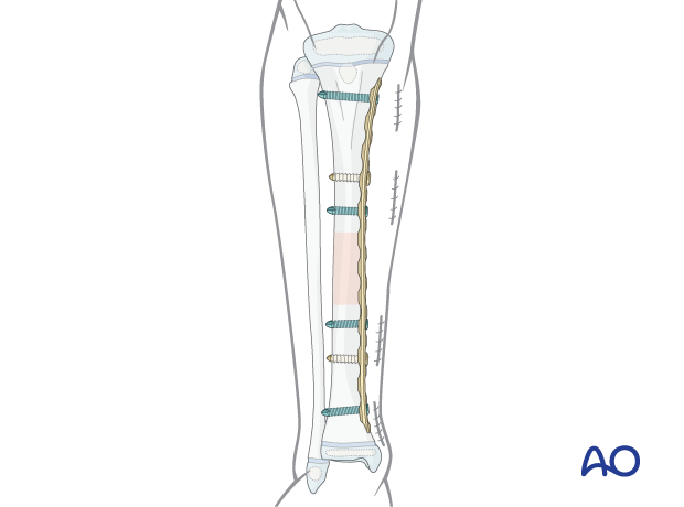 Minimally invasive plate osteosynthesis (MIPO) for stabilization of a pediatric tibial shaft fracture 