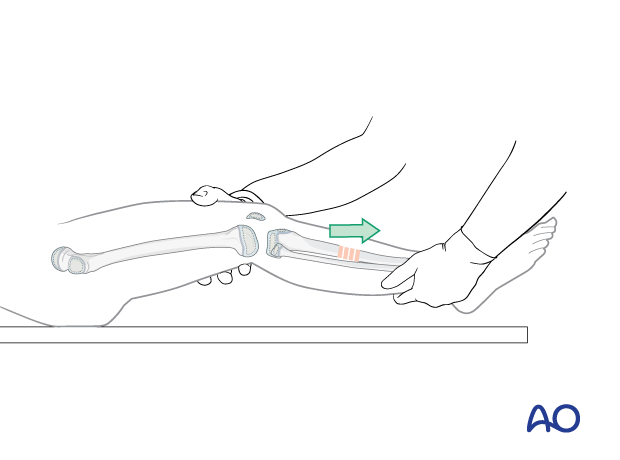 Manual closed reduction of a pediatric tibial shaft fracture