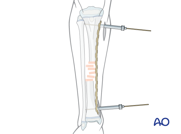 MIPO of a pediatric tibial shaft fracture - Temporary attachment of the plate with locking towers