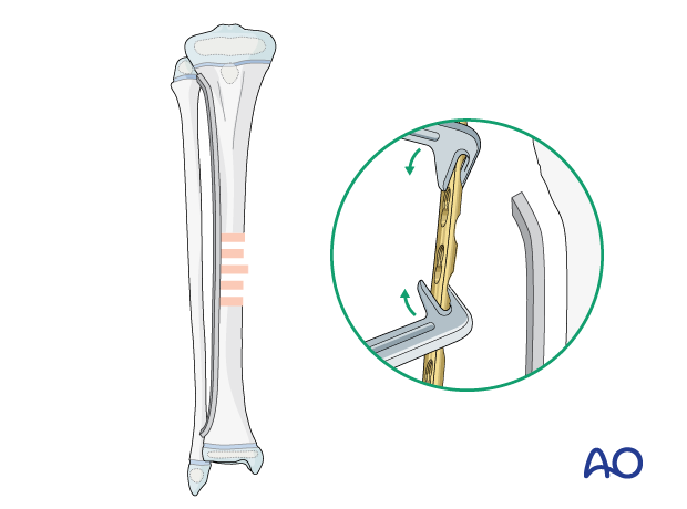 MIPO of a pediatric tibial shaft fracture - Contouring the plate