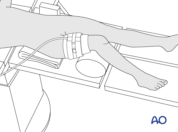 Supine position of a pediatric patient for surgery of the tibial shaft – tourniquet position