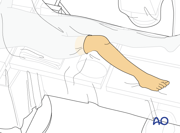 Supine position of a pediatric patient for surgery of the tibial shaft - draping